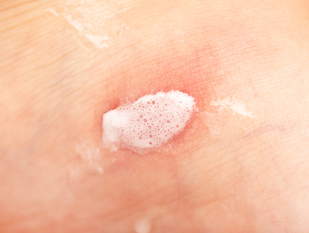 red leg wound