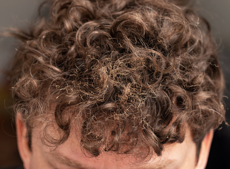 burnt hair on his headの写真素材