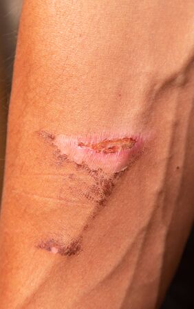 thermal burn on the skinの写真素材