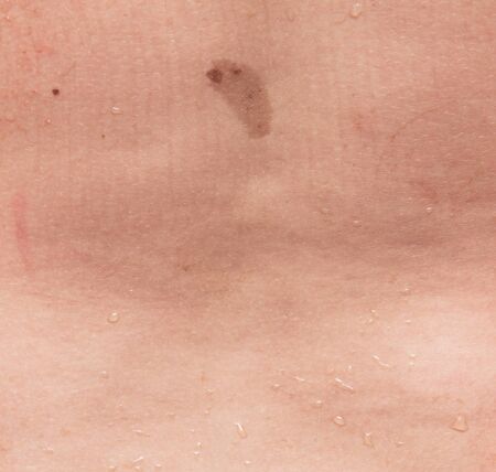 birthmark birthmark on the skinの写真素材