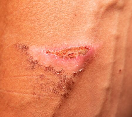 thermal burn on the skin