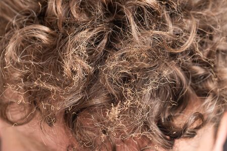 burnt hair on the headの写真素材
