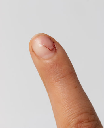 damage to the nail on the finger on a white backgroundの写真素材