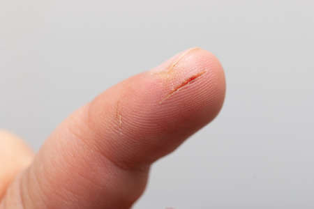 cut on the skin of a fingerの写真素材