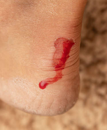 flayed skin on the leg with blood