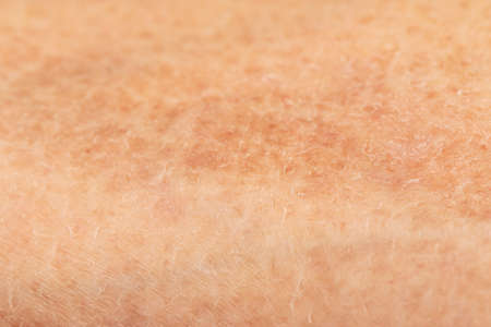 peeling skin on the arm as a background