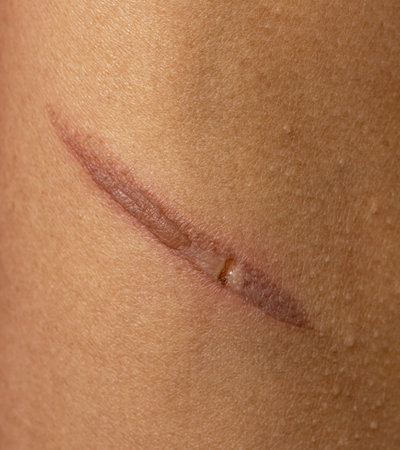 burn on hand as background