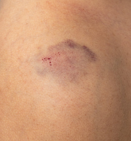 blue bruise on the skin of the armの写真素材