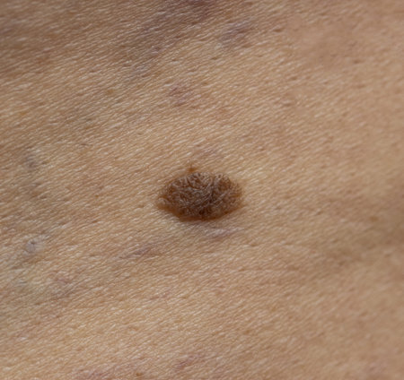 A mole is visible on the skin of a person. The mole is small and brown in color