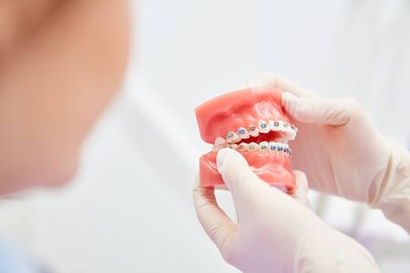 Gloves show a denture model with braces to correct a malocclusion