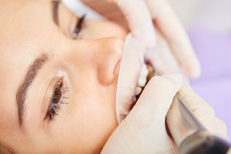Patient with protective mask on her mouth during professional teeth whitening at the dentist