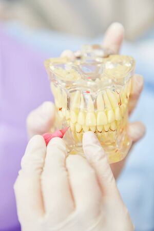 ZFA brushes the interdental spaces on a denture model with an interdental brush