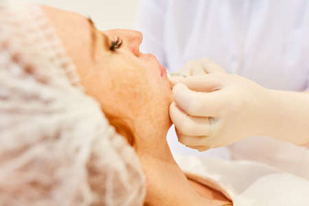 Woman applying hyaluronic acid as a dermal filler while injecting lips for lip enlargement