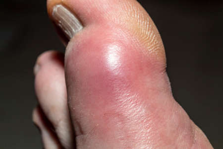 The inflammation and discoloration of the big toe due to Gout or uric acid crystals in the jointsの写真素材