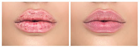 Lips. Close up of chapped, cracked lips, dry skin problem with mouth disease before and after treatment. Healthy woman lips, macro shotの写真素材