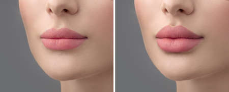 Before and after lip filler injections. Fillers. Lip augmentation Beautiful Perfect Lips. Sexy Mouth close-up. Beauty young woman Lips. Plastic surgery. Close upの写真素材