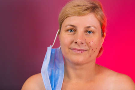 The close up picture of senior woman with hair pulled back having acne after wearing the medical mask a long time in pandemic.の写真素材