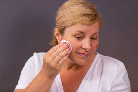 A woman with problematic skin having acne, could get rid of acne on one cheek using cotton disk with remedy wiping it.の写真素材