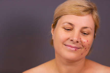 Close up photo of a pretty adult woman blonde smiling after acne removal procedure on one cheek in the beauty salon.の写真素材