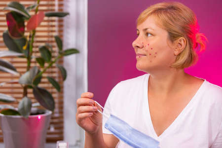 After wearing a long time a medical mask acne appeared on the woman face, she feels irritation and pain, treatment needed.の写真素材
