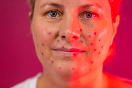 Close up photo of a worried woman about her acne problem feeling irritation pain and she undergoes an ultraviolet procedure to remove acne spots from her face.の写真素材