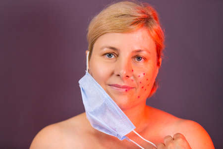 The close up photo of a blonde woman got off the medical mask and she noticed the appearance of the acne problem on her face.の写真素材