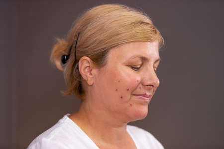 Profile photo of a smiling woman having acne on her face, she feels irritation on her face after wearing the medical mask.の写真素材