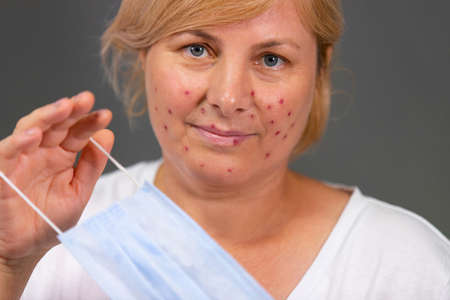 Close up photo of a pretty blonde woman with irritating red spots on her face, she has acne problem and holding a medical mask on her palm.の写真素材