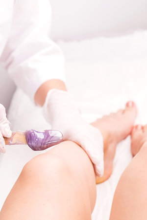 Beautician in white gloves applies violet warm wax with a wooden stick help on the patient woman leg in the beauty salon.の写真素材
