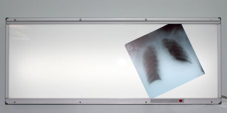 chest radiographs located on negatoscopeの写真素材