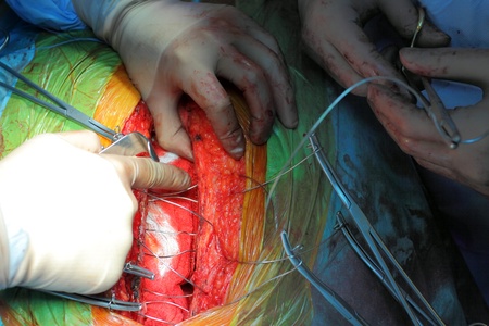 Surgical wound and the work of surgeons   trailing phase of cardiac surgery のeditorial素材