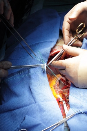 Cardiac surgery  Suturing in the mitral valve ring  Professional information のeditorial素材