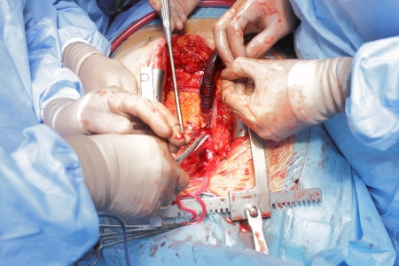 Surgical treatment  Operating wound and hand surgeons の写真素材