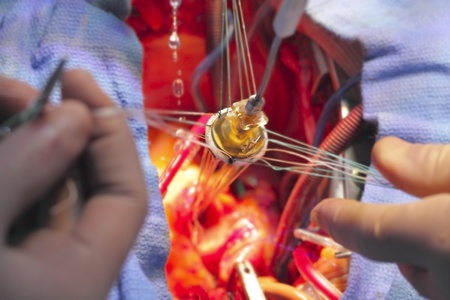 artificial heart valve in the implantation process の写真素材
