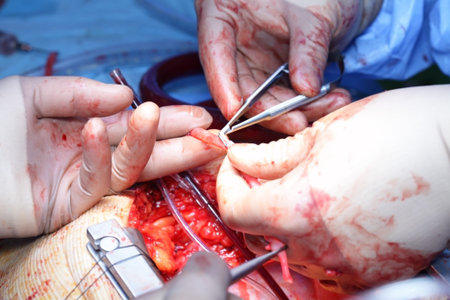 Working with the vein  Coronary artery bypass surgery  Cardiac surgery 