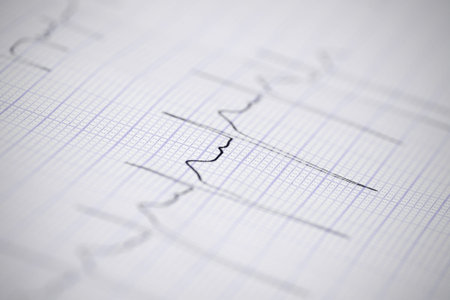 ECG