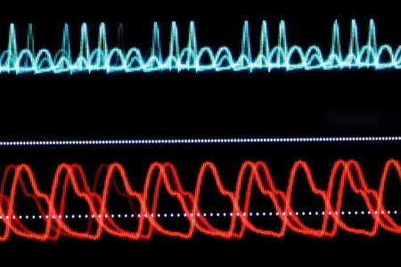 ECG graph on the monitor pixelated