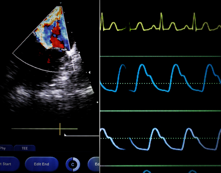 Echocardiographic parameters synchronized with ECG. Screen of a modern medical monitor.の写真素材