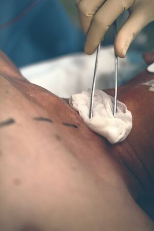 Medical nurse treats of male patient with gauze swab in disinfectant solution before the surgical operation.の写真素材