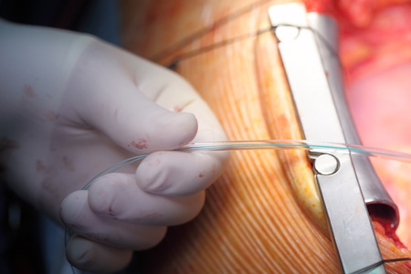 Surgeon's hand, which performs manipulation in the operating wound.の写真素材