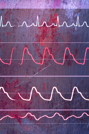 ECG lines on the old rusty metal sheet, textured medical background.の写真素材
