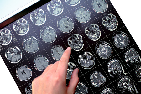 Finger pointing on the affected area in the patient's head on the MRI image.の写真素材