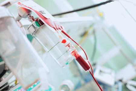 Blood bag hanging on the tripod during blood transfusion therapy in the intensive care.の写真素材
