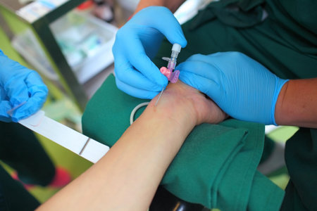 Installation of a catheter into the radial artery. Preparing for surgery.