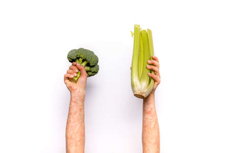 Broccoli, celery and psoriasis handsの写真素材