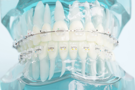 orthodontic model and dentist tool - demonstration teeth model of varities of orthodontic bracket or braceの写真素材