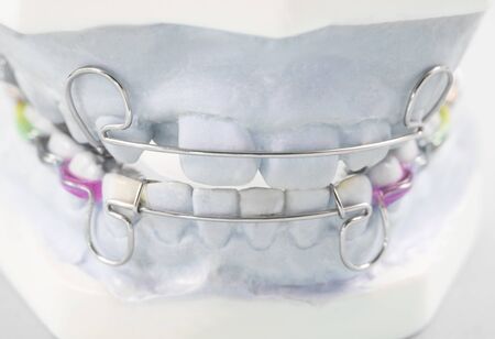orthodontic model and dentist tool - demonstration teeth model of varieties of orthodontic bracket or braceの写真素材