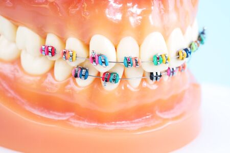 orthodontic model and dentist tool - demonstration teeth model of varities of orthodontic bracket or braceの写真素材