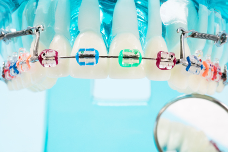 orthodontic model and dentist tool - demonstration teeth model of varities of orthodontic bracket or braceの写真素材