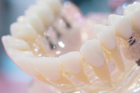 implant and orthodontic model for student to learning teaching model showing teeth.の写真素材